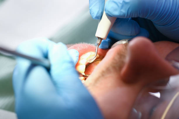 Best Broken or Cracked Tooth Emergency Dentist in Martha Lake, WA
